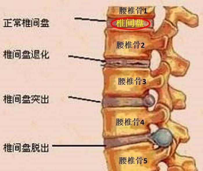 腰椎间盘突出是什么引起的、腰间盘突出能彻底好吗
