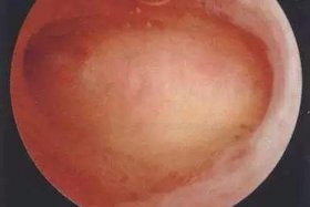 专业补网，做宫腔镜宫底内突什么意思