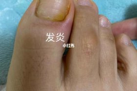 去医院治疗甲沟炎大概需要多少钱 - 去医院治疗甲沟炎大概需要多少钱一次