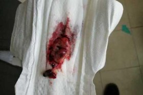 药流大概需要多少钱 - 吃药流产几个小时流出来