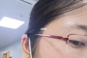 大概需要多少钱呢；激光去黑色素大概需要多少钱呢