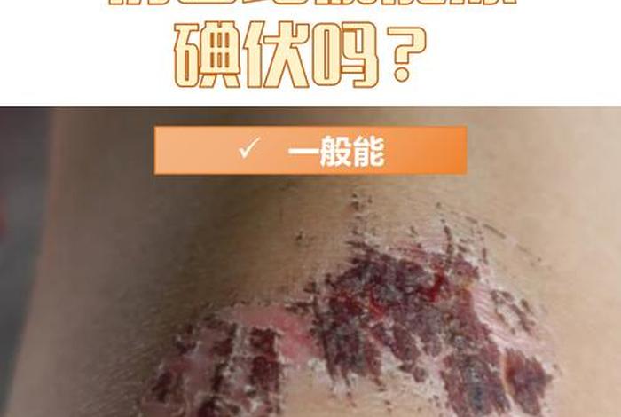 碘伏伤皮肤吗 - 碘伏伤皮肤吗图片