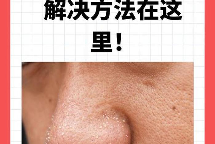 鼻子上有痘痘怎么快速去除,鼻子上有痘痘怎么快速去除掉 鼻子上有痘痘怎么快速去除,鼻子上有痘痘怎么快速去除掉