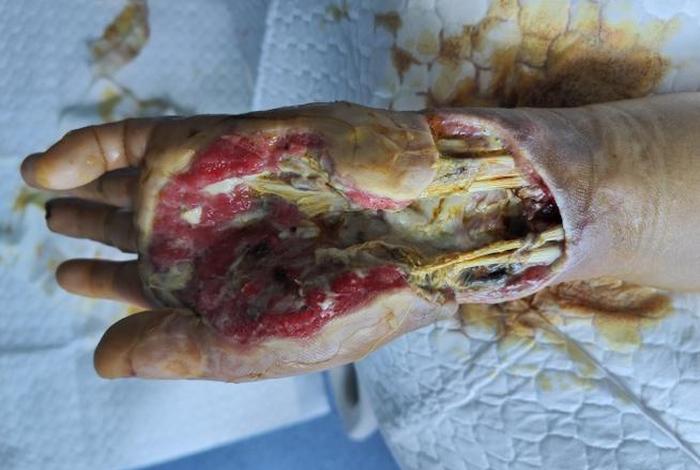 电创伤图片 - 电伤的图片 电创伤图片 - 电伤的图片