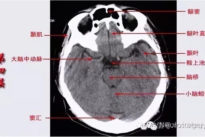 颅底鞍上池铸型强化最常见于什么 颅底鞍上池铸型强化最常见于什么骨折 颅底鞍上池铸型强化最常见于什么 颅底鞍上池铸型强化最常见于什么骨折