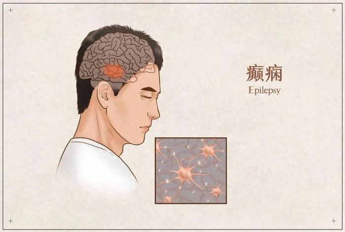 癫火伤害类型、癫痫上火 癫火伤害类型、癫痫上火