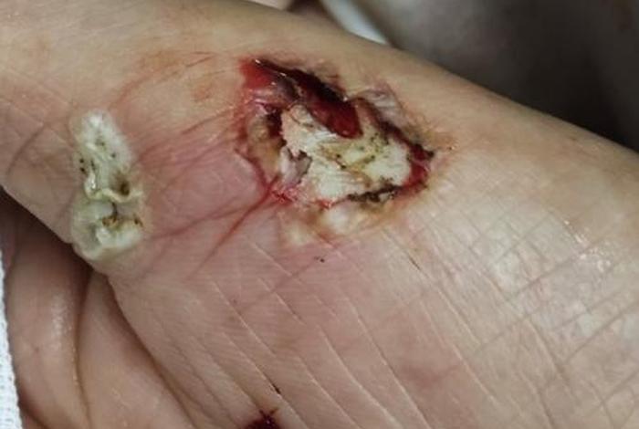 电创伤图片 - 电伤的图片 电创伤图片 - 电伤的图片